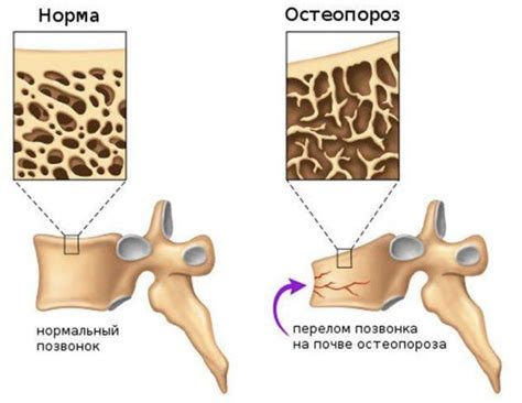 Причины множественных грыж шморля