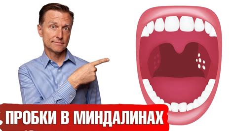 Причины налета на гландах