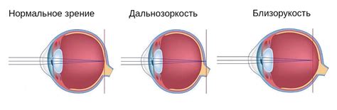 Причины напряжения аккомодации глаза