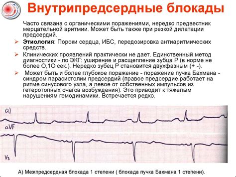 Причины нарушения внутрипредсердной проводимости на ЭКГ