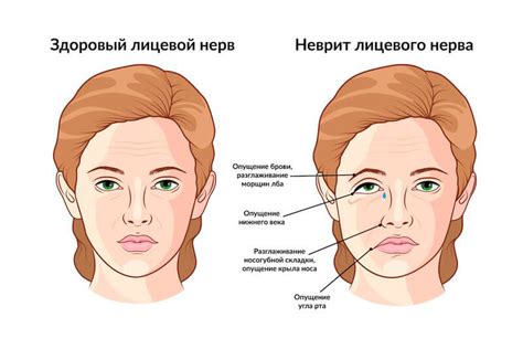 Причины невралгии лицевого нерва