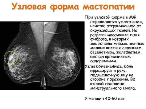 Причины не соответствия морфотипа молочной железы возрасту