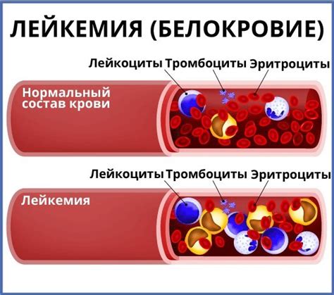 Причины низкого уровня лития в крови