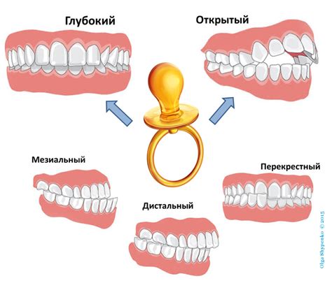 Причины ножницеобразного прикуса