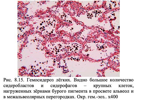 Причины обызвествления очагов