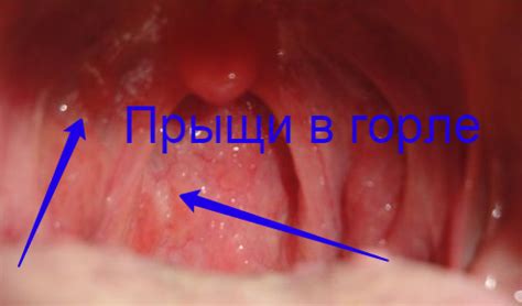 Причины острого воспаления горла