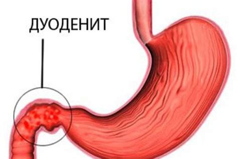 Причины поверхностного дуоденита