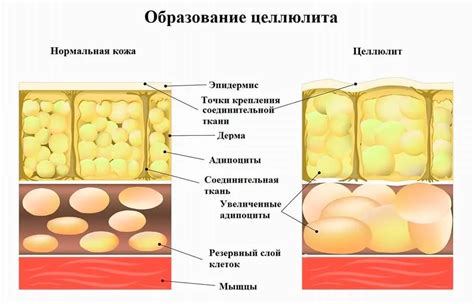 Причины появления целлюлита и методы его устранения