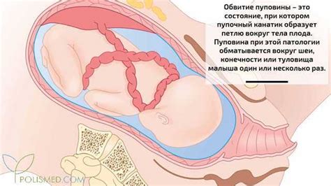 Причины пуповины около шеи: