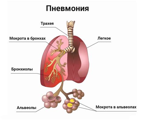 Причины развития вирусной бактериальной пневмонии