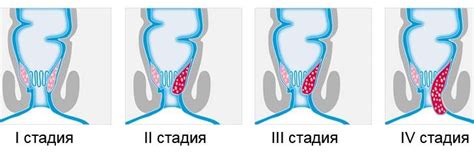 Причины развития геморроя 3-ей степени