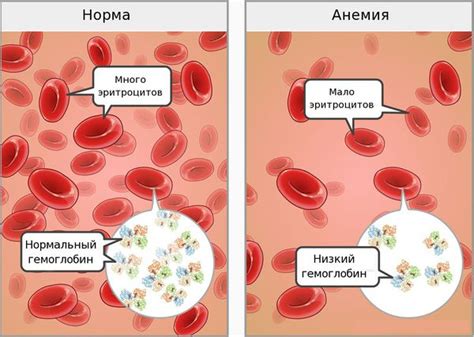 Причины развития железодефицитной анемии 1 степени