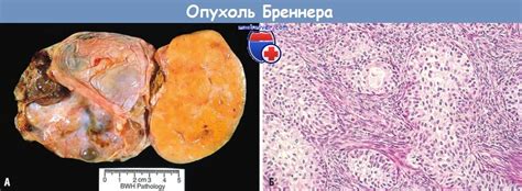 Причины развития инфильтрирующей опухоли