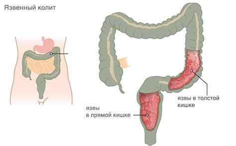 Причины развития колита в лице