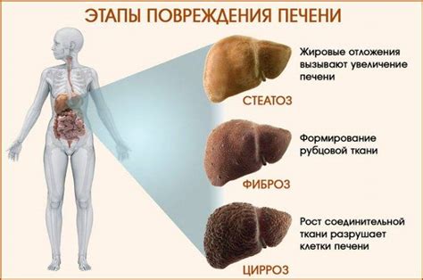 Причины развития начальной стадии цирроза печени