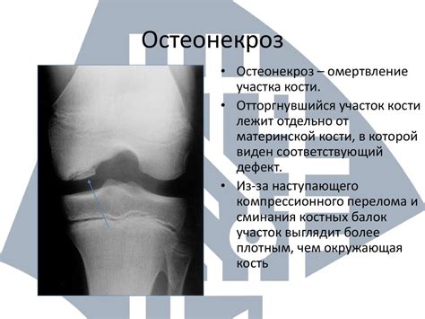 Причины развития некроза коленного сустава