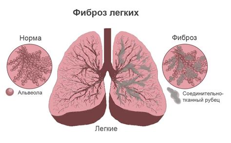 Причины развития новообразования в легких после COVID-19