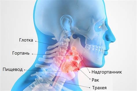 Причины развития рака гортани второй степени