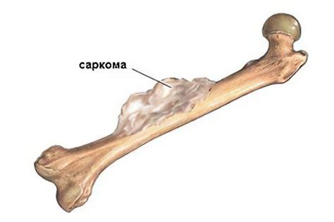 Причины развития саркомы кости