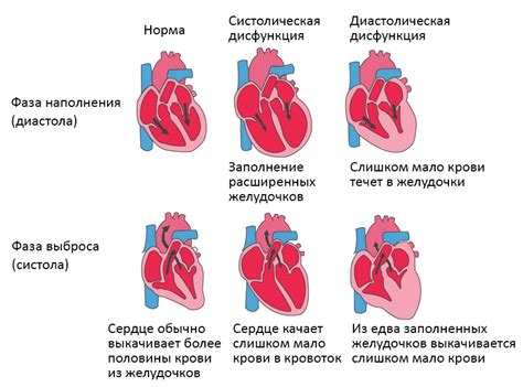Причины развития сердечной недостаточности 2 степени