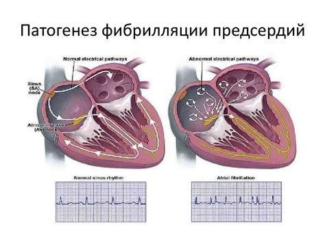 Причины развития фибрилляции предсердий