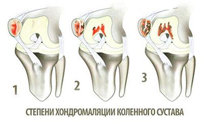 Причины развития хондромаляции коленного сустава 3 степени