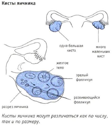 Причины развития яичниковой кисты