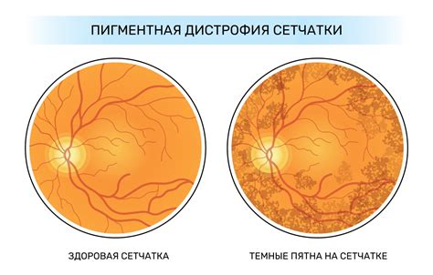 Причины разряженной сетчатки