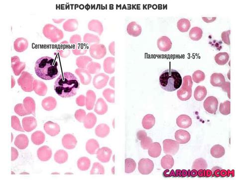 Причины сдвига лейкоцитарной формулы вправо