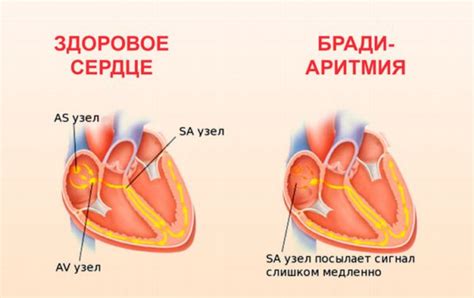 Причины синусовой брадиаритмии