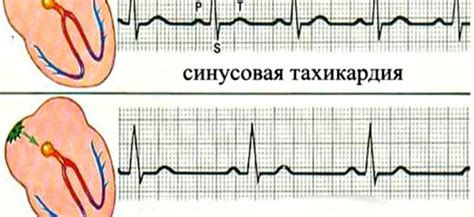 Причины синусовой тахикардии у взрослых