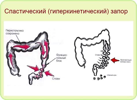 Причины спастического запора