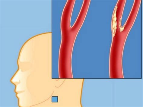 Причины стеноза сосудов шеи