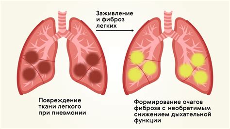 Причины схлопывания легких