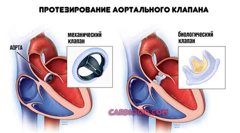 Причины увеличенного левого предсердия