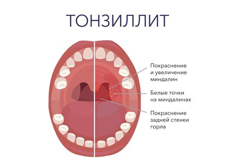 Причины уменьшения миндалин