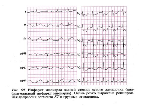 Причины умеренных изменений миокарда нижней стенки левого желудочка