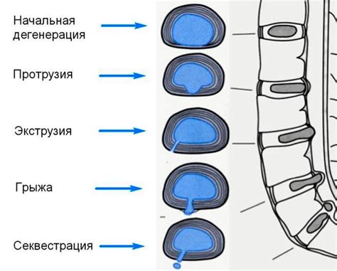 Причины экструзии межпозвонковых дисков