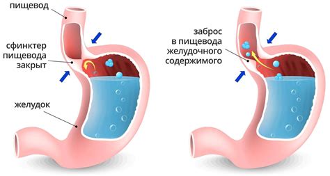 Проблема миграции желудочного содержимого в пищевод