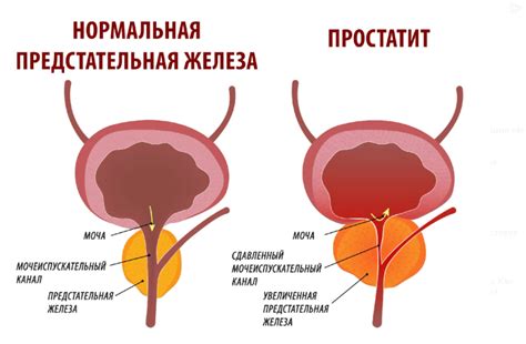 Проблемы простаты и их влияние