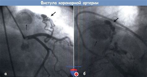 Прогнозы и последствия коронарной фистулы у детей