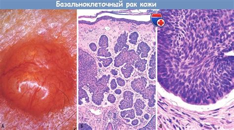 Прогнозы и профилактика базальноклеточной карциномы