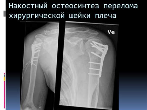 Прогноз при вколоченном переломе шейки плеча