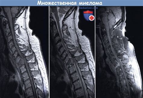 Прогноз при литическом поражении позвоночника