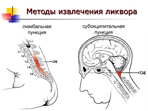 Происхождение опалесцирующего ликвора