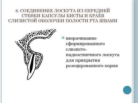 Происхождение остаточной полости кисты