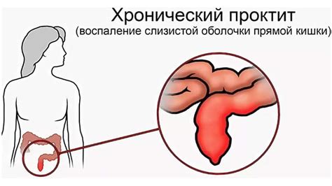 Проктит: какие симптомы нужно знать