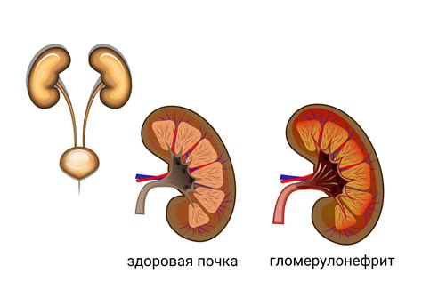 Пролиферативный гломерулонефрит: что это такое?