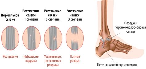 Профессиональное лечение растяжения связок