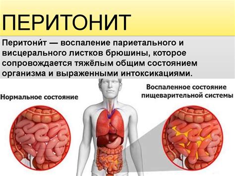 Профилактика возникновения перитонита